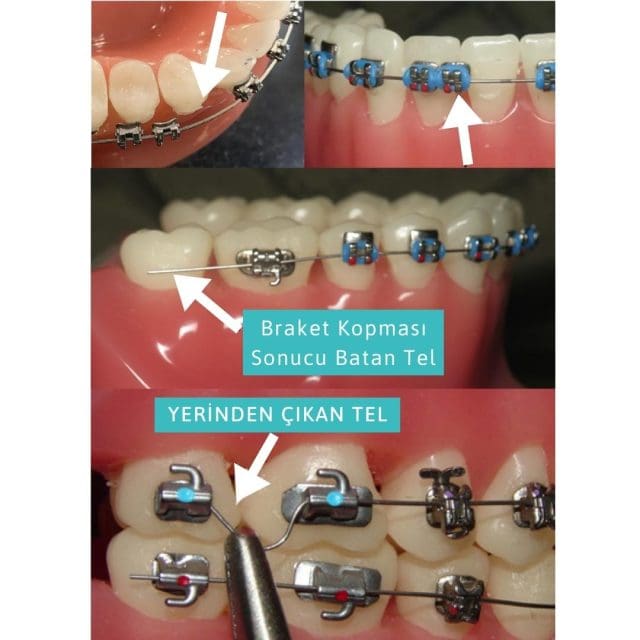 bracket breakage