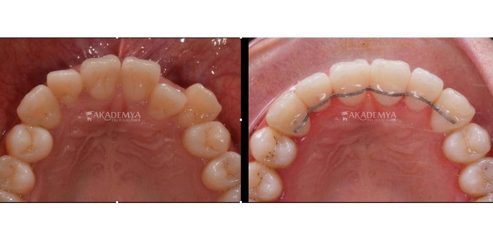 lingual retainer