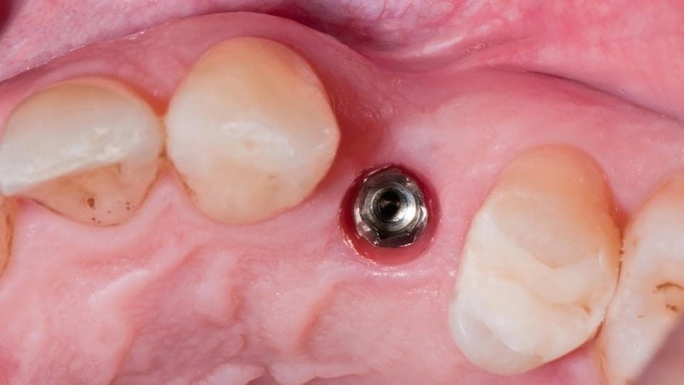 tooth extraction and implant teeth