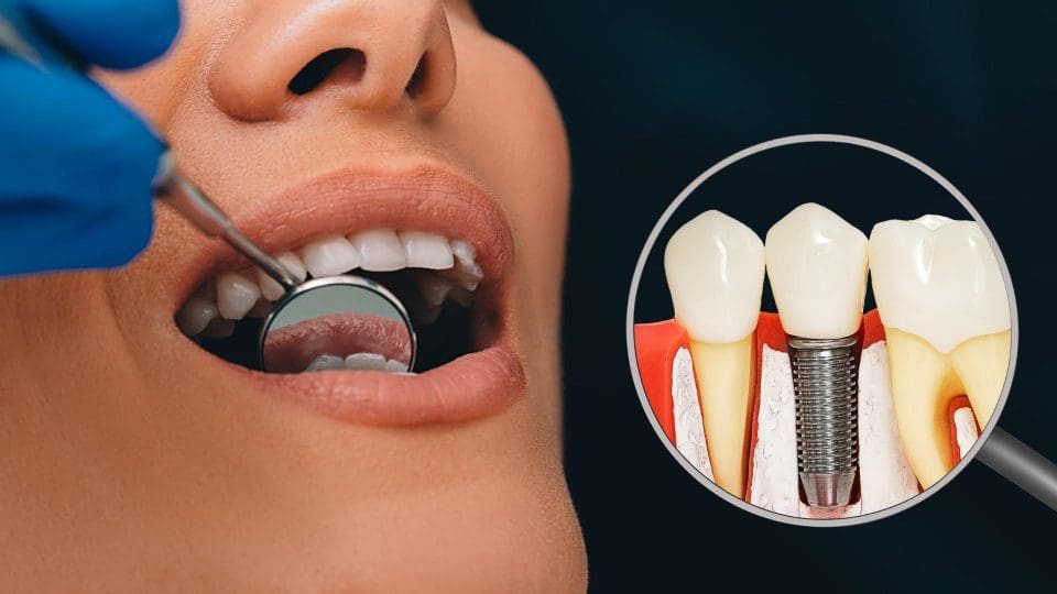 implant diş ne zaman