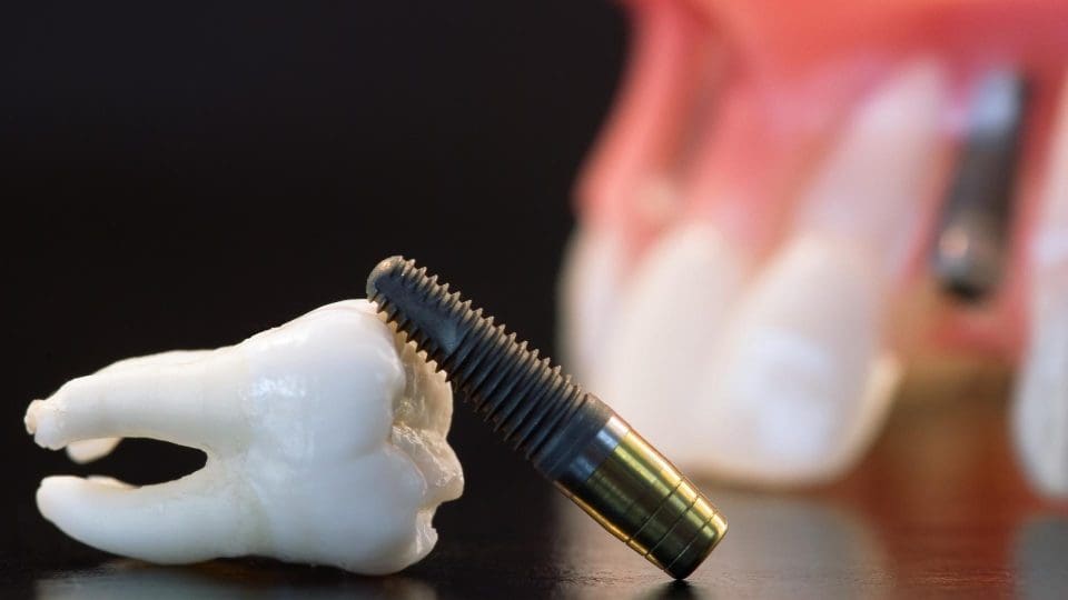 implant diş