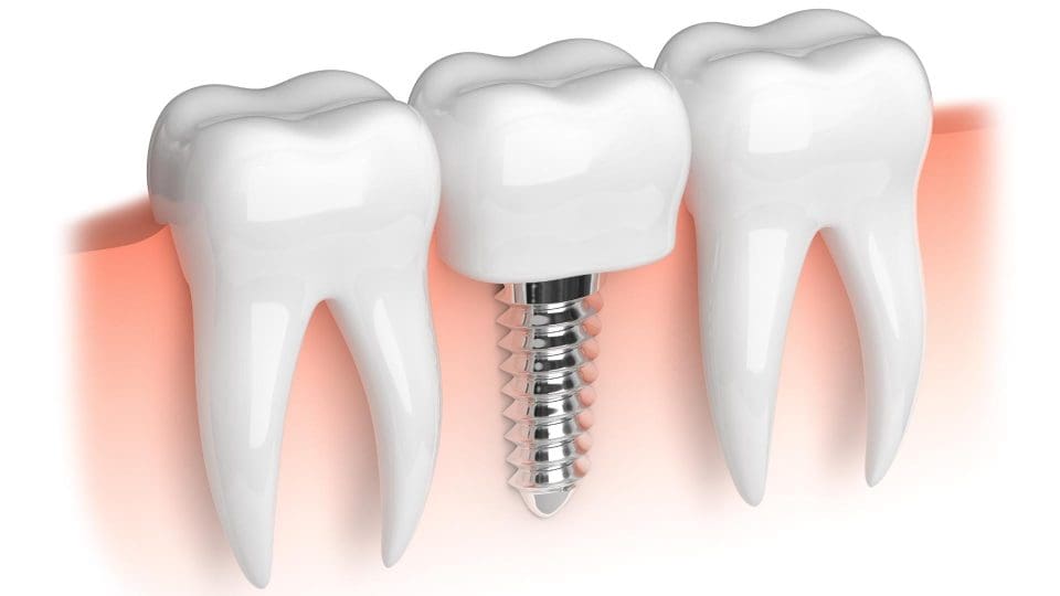 implantat nevsehir