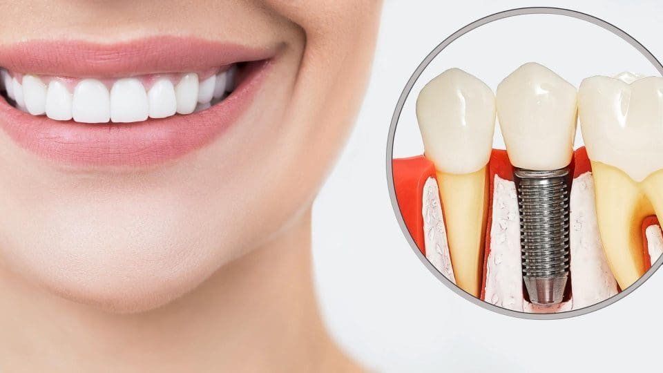 implant diş nedir