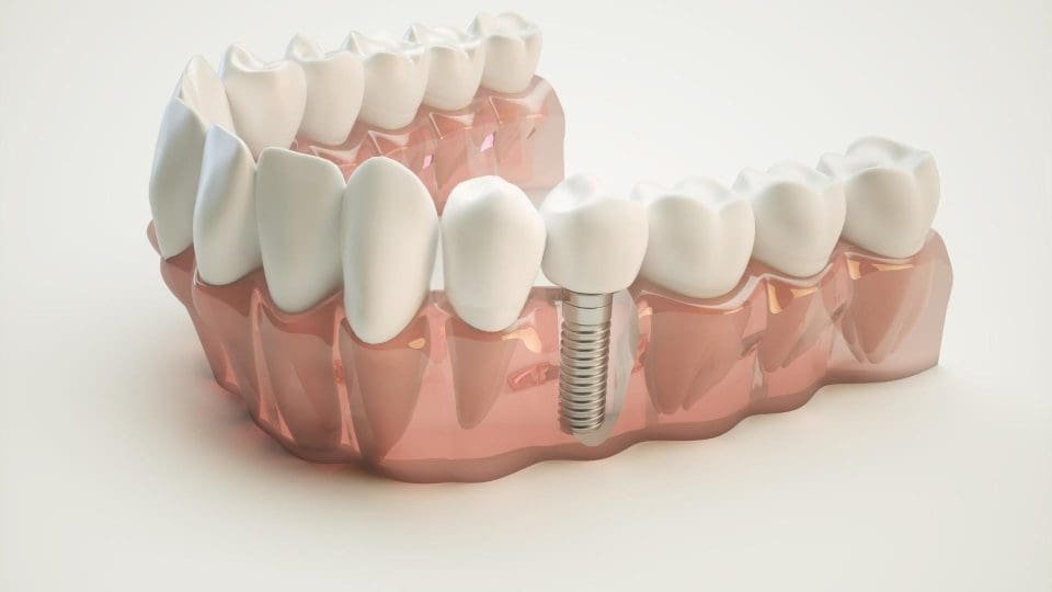 implant diş nevşehir