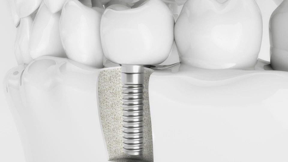 nevşehir implant diş ücretleri