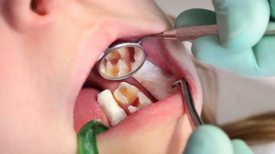 tooth filling falling out