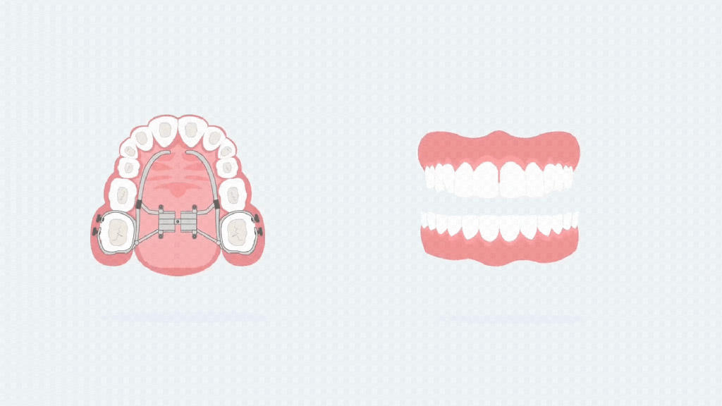 upper jaw expansion