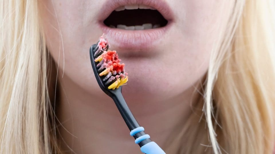 gum bleeding