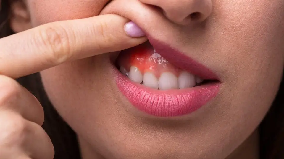 gum swelling