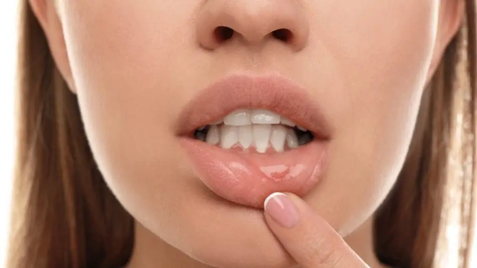 canker sores aft