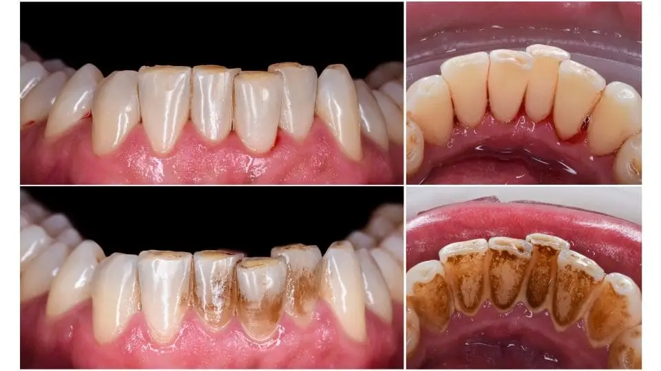 dental stone cleaning