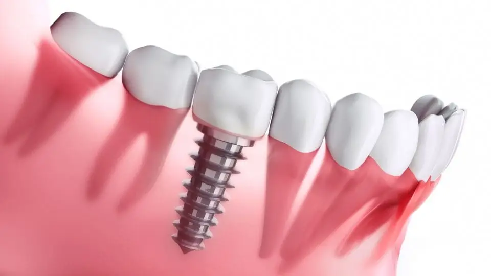 implant dental brands