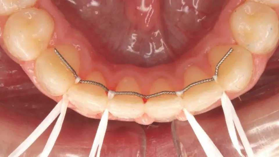 protective inner wire