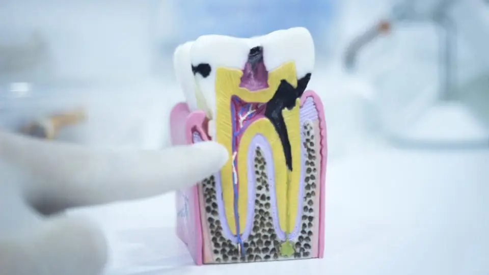 dental çürük