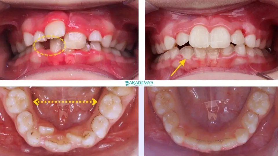 chin enlargement in children