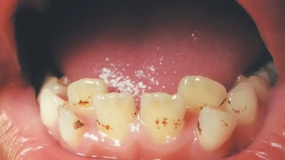 black tooth stain
