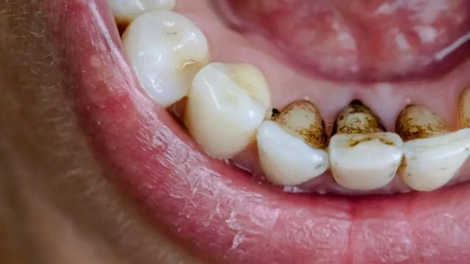 black tartar dental stone
