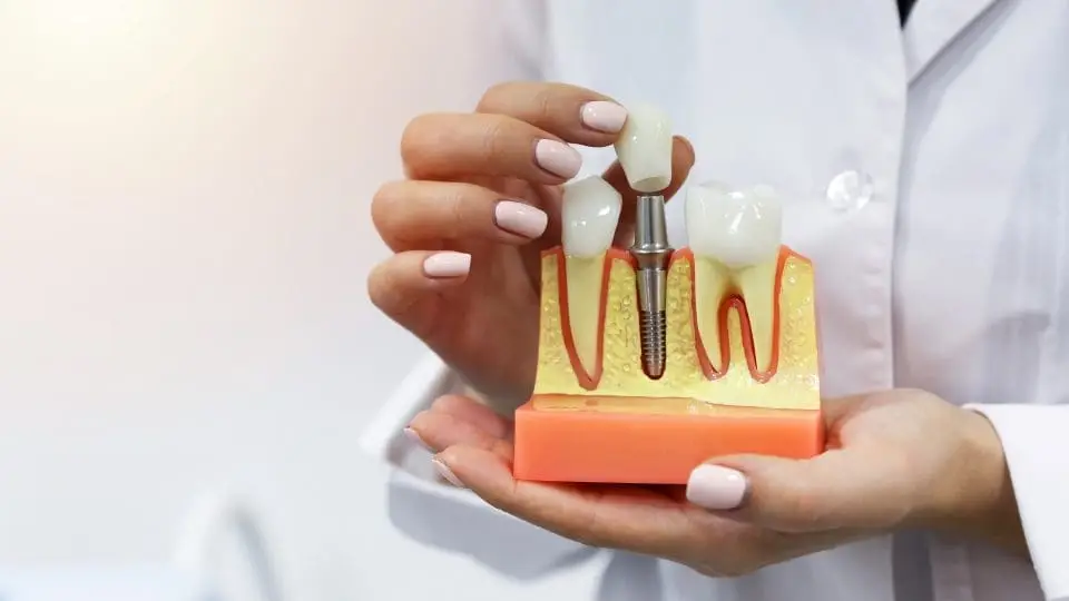 dental implants