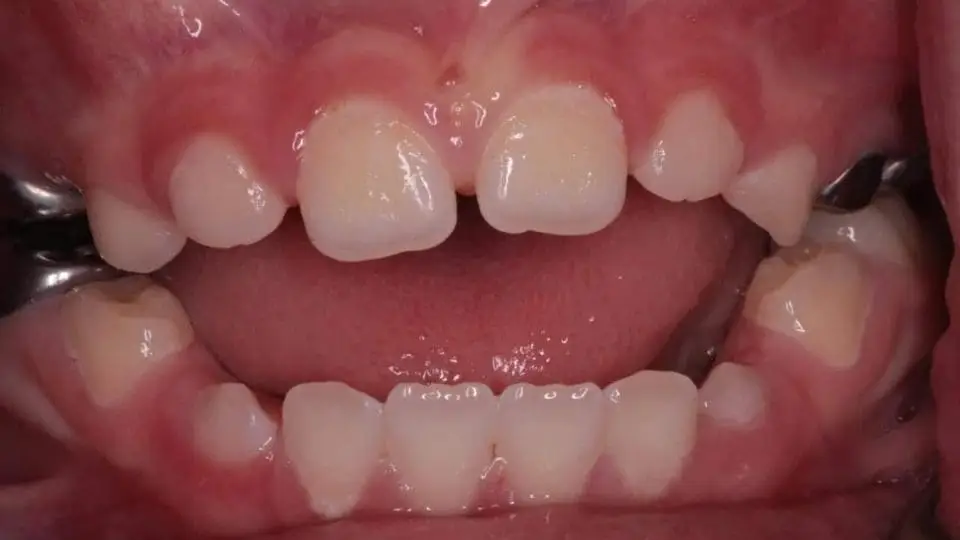 open bite in children